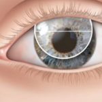 Les lentilles multifocales