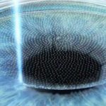 Opération presbylasik